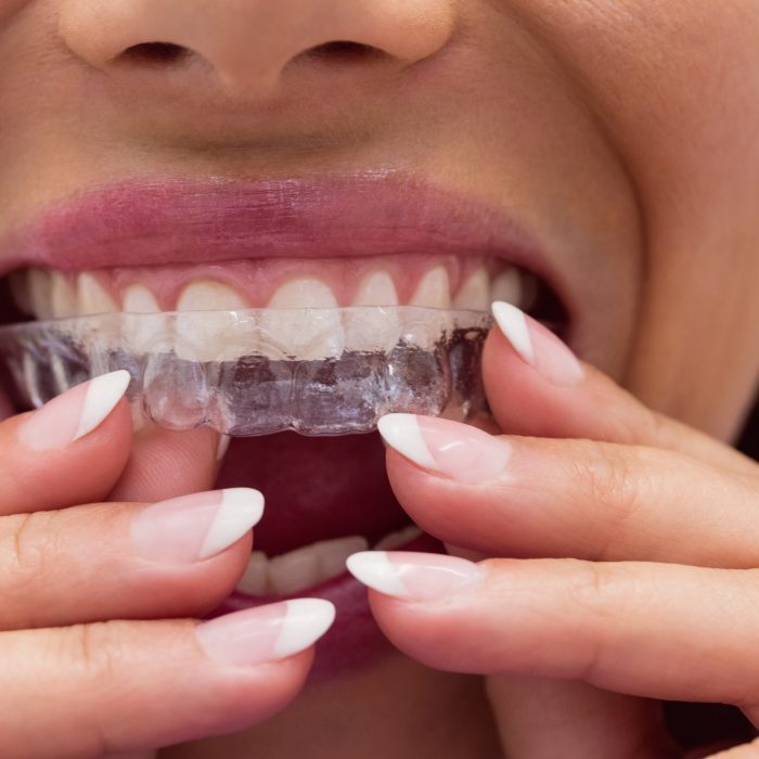 invisalign-torino